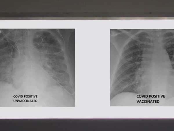 So sánh ảnh chụp phổi của bệnh nhân COVID-19 đã tiêm và chưa tiêm vaccine, phát hiện điều kinh ngạc