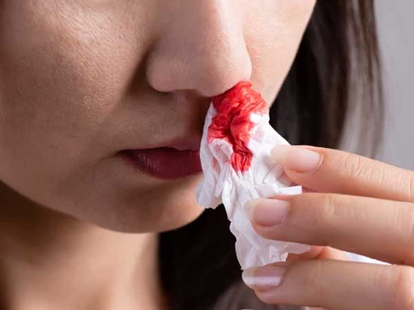 Bị chảy máu cam, ngửa cổ hay nhét giấy vào mũi mới đúng? Hóa ra trước giờ chúng ta vẫn làm sai cách đấy