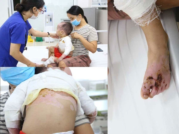 Bị đổ cả nồi chè đỗ đen nóng vào người, bé 2 tuổi bị sốc bỏng độ 2-3