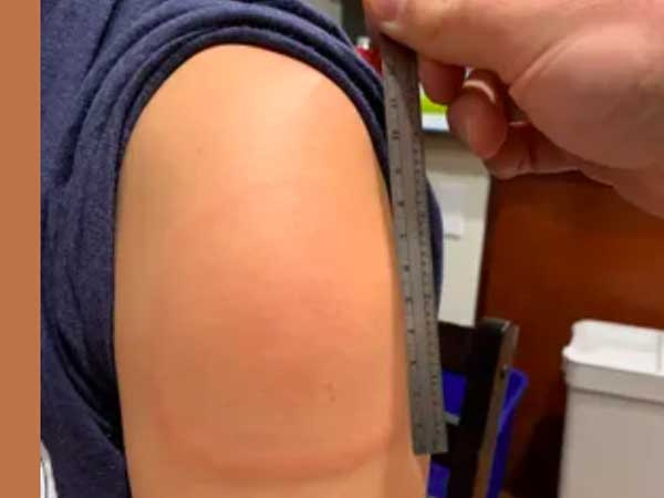 Vì sao có triệu chứng 'cánh tay COVID' sau tiêm vaccine Moderna?
