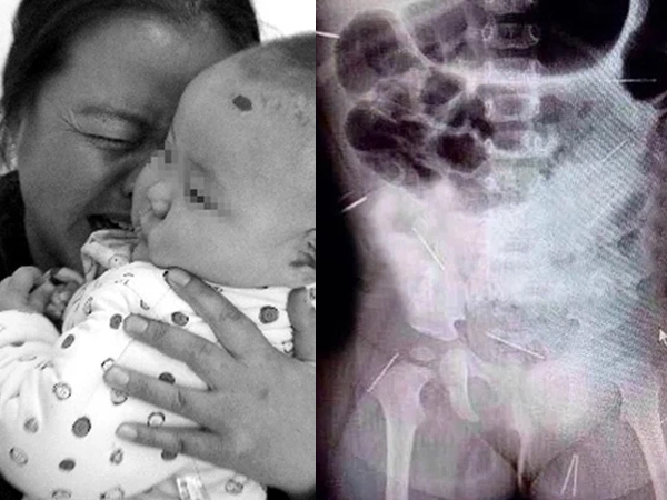 Con gái quấy khóc, mẹ quặn lòng trước tấm phim cho thấy 12 cây kim trong cơ thể đứa trẻ, nghi phạm bị vạch trần vì câu hỏi vu vơ