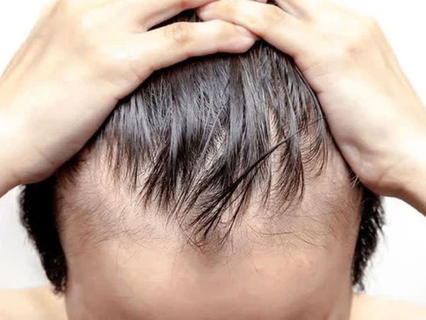 Cẩn thận nếu đầu tóc bạn xuất hiện 6 dấu hiệu này: Bết, thưa, rụng hay bạc sớm không đáng sợ bằng điều này