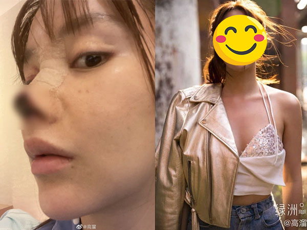 1 năm sau vụ phẫu thuật thẩm mỹ thất bại khiến mũi bị hoại tử, nhan sắc của mỹ nhân đình đám Cbiz lột xác hoàn toàn