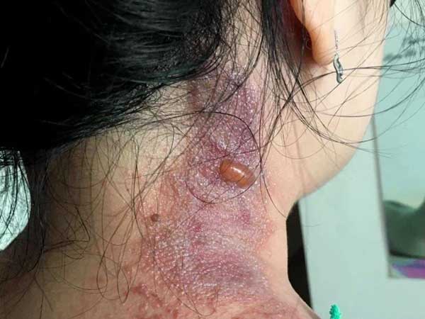 Viêm da vì kiến ba khoang, nhiều bệnh nhân gánh hậu quả mùa dịch