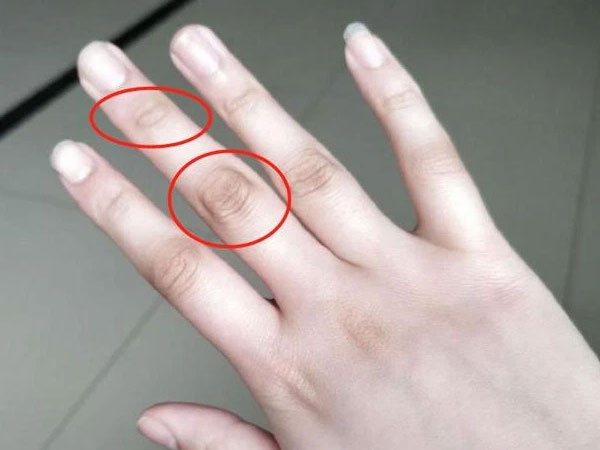 4 dấu hiệu bất thường ở ngón tay giữa cảnh báo gan đang yếu, nên đi khám ngay