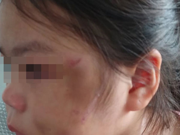 Bé gái 6 tuổi ở Bình Dương bầm tím mặt vì cha 'lỡ tay khi dạy học'
