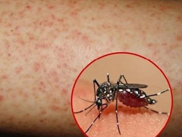 Bé gái 9 tuổi tại Hà Nội nguy kịch vì sốt xuất huyết: Bác sĩ gửi lời cảnh báo khẩn thiết tới phụ huynh