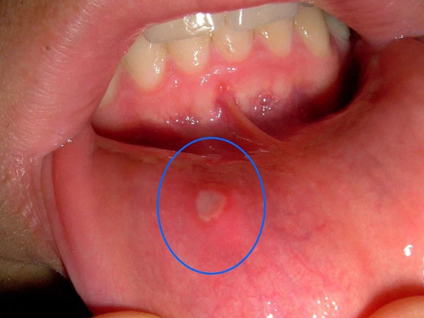 Đây là hiện tượng xuất hiện ở miệng mà 90% người mắc phải có thể là dấu hiệu cảnh báo ung thư nhưng không ai để ý