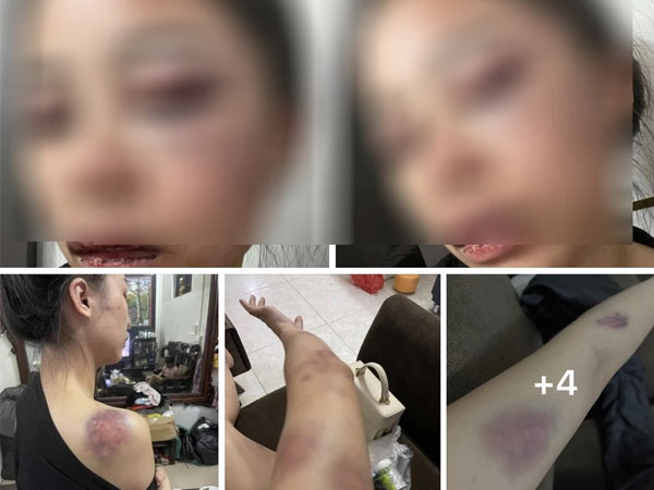 Vợ tố chồng bạo hành từ 23 giờ đêm đến 4 giờ sáng, gương mặt bị đánh tới biến dạng