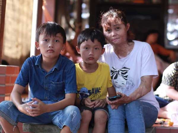 Người phụ nữ bị chồng thiêu sống bỏng đến 92%: 'Khi các con đã đi ngủ, tôi khóc ướt gối'