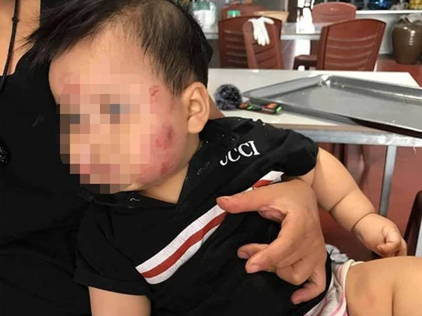 Cơ sở mầm non nơi bé 2 tuổi bị bạn đánh dã man từng bị 'bóc phốt': Con đi học về bầm tím mặt mũi, cô giáo nói do bỉm chật