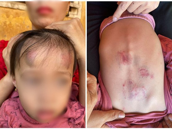 Vụ bé gái 2 tuổi bị bạn học đánh đạp dã man: Lãnh đạo xã khẳng định sẽ đóng cửa cơ sở nếu có sai phạm, chia sẻ về tình hình hiện tại của cháu bé