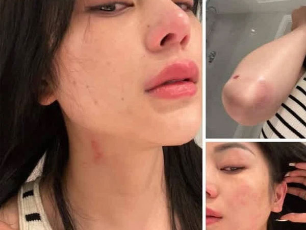 Lily Chen tung loạt ảnh bị hành hung, tiết lộ ai đó đặt chuyện hãm hại giữa drama với 'nữ hoàng nội y'?