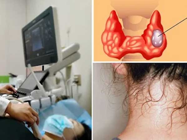 Cô gái trẻ 25 tuổi bị bệnh tuyến giáp giai đoạn cuối, bác sĩ nói: Cẩn thận với một kiểu đổ mồ hôi