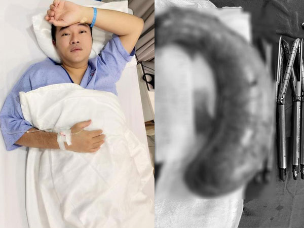 Ca sĩ Minh Quân gây choáng khi đăng ảnh dạ dày của mình bị cắt đến 80%, tiết lộ đã sút 10kg sau cuộc đại phẫu