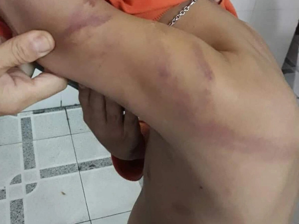 Cha đánh con lớp 1 thâm tím người vì học không tiến bộ