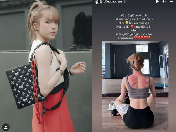 Thiều Bảo Trâm lên tiếng trấn an mọi người sau khi cơ thể lộ nhiều vết đỏ bầm nhưng lại bị anti-fan mắng mỏ nặng lời