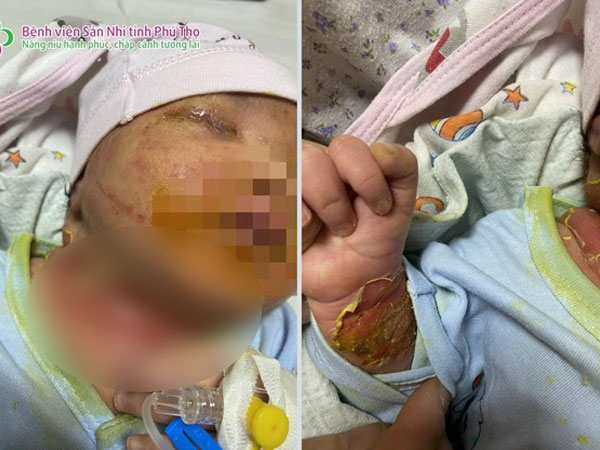 Bé gái sơ sinh lở loét toàn thân, nghi nhiễm trùng máu do mẹ sợ Covid-19, tự đắp thuốc điều trị cho con