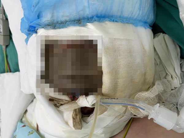 Xông lá thuốc để phòng Covid-19, bé gái ngã úp mặt vào nồi nước sôi nguy kịch