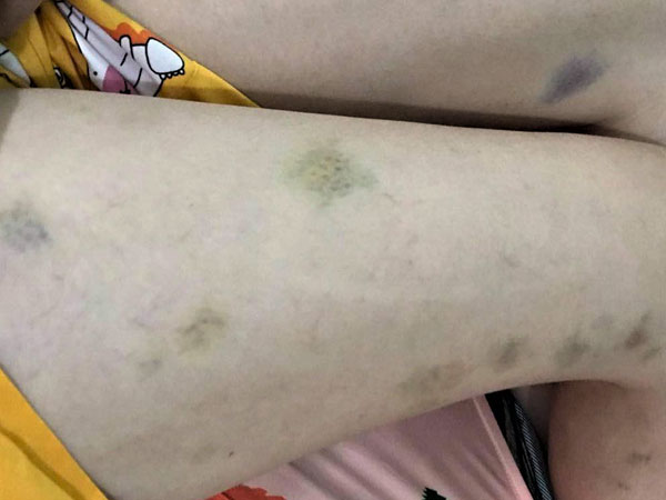 Vết thâm bất thường cảnh báo nhiều loại bệnh