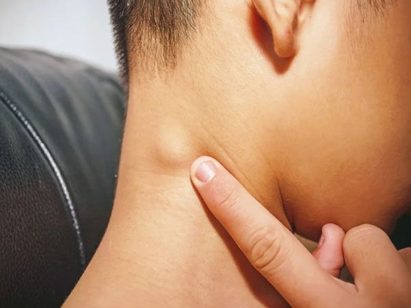 Nổi hạch sau tiêm mũi 3 vaccine Covid-19, có nguy hiểm không?