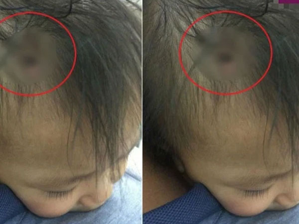 Sự thật về bức ảnh bé gái 3 tuổi bị bạo hành với chiếc đinh lớn cắm thẳng vào đầu khiến MXH xôn xao