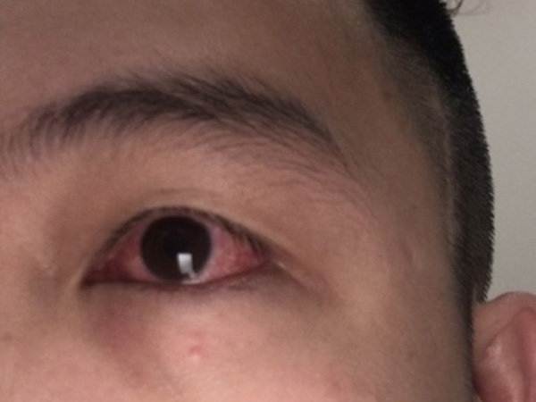 F0 bị đỏ mắt, bác sĩ cảnh báo 'triệu chứng không thể chủ quan'