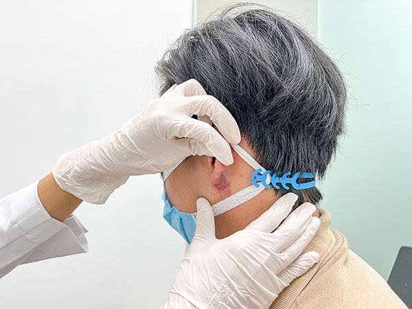 Loét, hoại tử tai vì tạo hình theo phong thủy