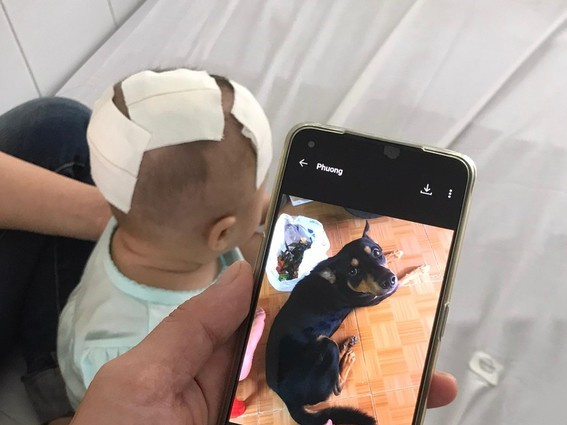 Xót xa bé gái 6 tháng tuổi bị chó cưng cắn xuyên xương sọ