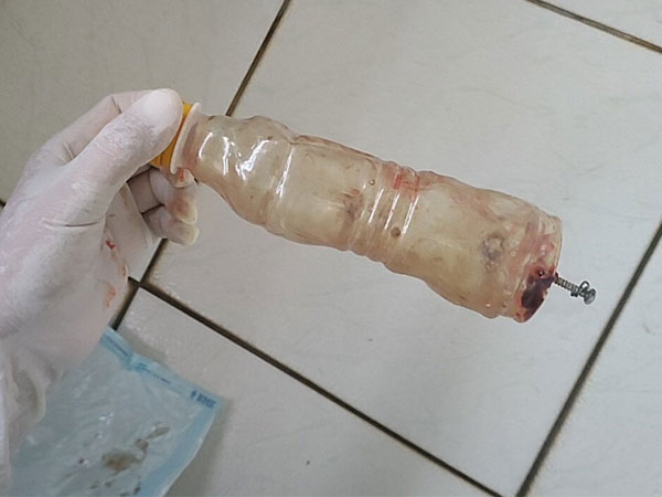 Mắc kẹt dị vật khủng trong hậu môn, thầy phán 'bị yểm bùa trong bụng'