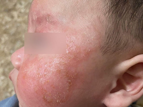 Kiêng tắm 6 ngày khi mắc Covid-19, da trẻ đóng vảy, đỏ lừ