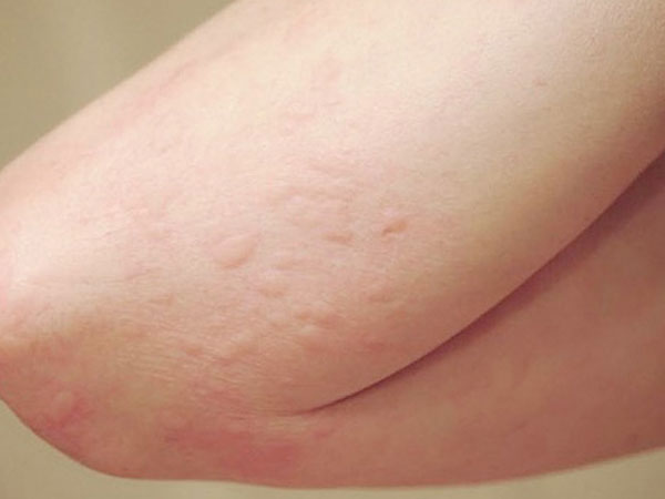 Di chứng ‘mày đay khổng lồ’ hậu Covid-19, chữa thế nào?