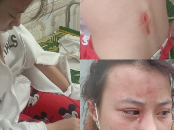 Nữ sinh lớp 10 bị hàng xóm hành hung đến ‘chấn động não’