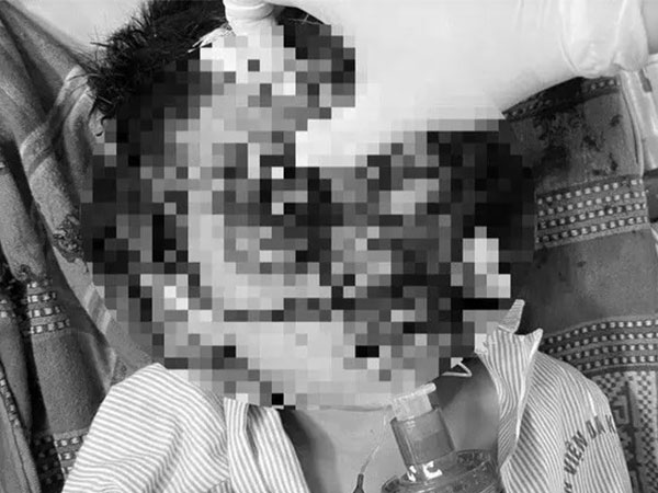 Nghịch súng, bé trai bị 11 viên đạn bi găm vào đầu tử vong