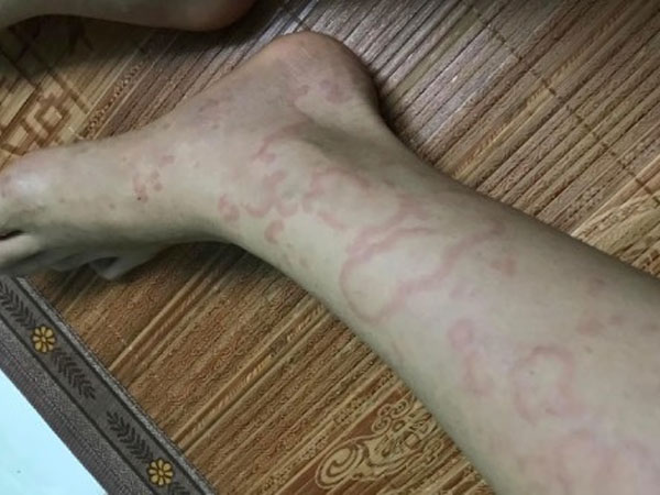 Vì sao nhiều người gãi rách da, rách thịt hậu Covid-19?