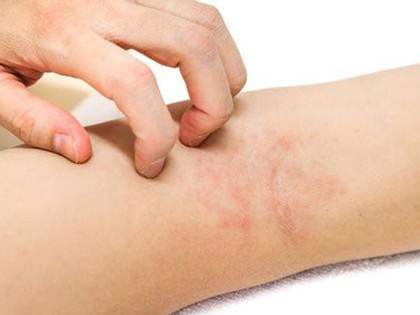 Ngứa da điên cuồng, có thể bạn đã mắc phải một trong các 'trọng bệnh' sau