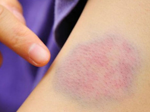 Đột nhiên xuất hiện vết bầm tím trên da coi chừng mắc 5 bệnh nguy hiểm: Chuyên gia cảnh báo dấu hiệu cần đi khám sớm