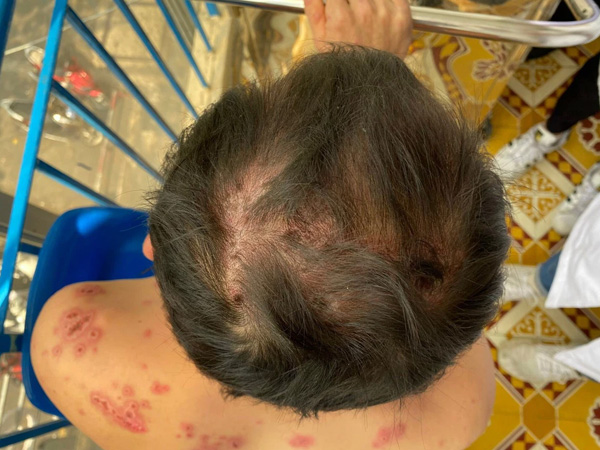 Nam thanh niên mắc phải căn bệnh cực hiếm, cả thế giới chỉ có 95 người