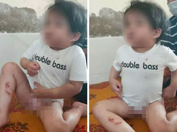 Bé gái 4 tuổi bị dì ruột dùng cán chổi, móc áo đánh đập trong 3 ngày