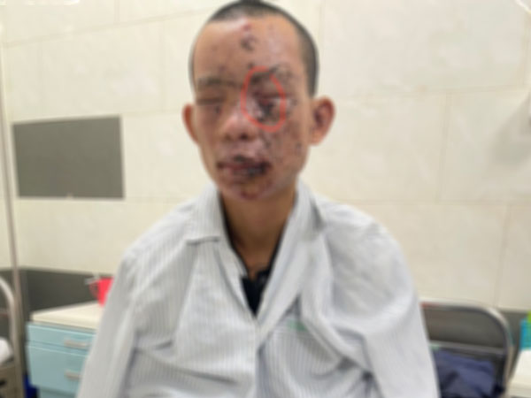 Cháy sém toàn thân, mất thị lực do dùng điện thoại khi đang sạc