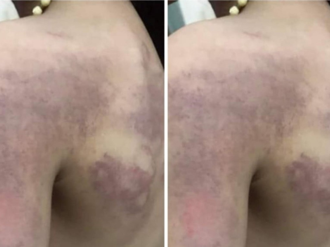 Nghệ An xác nhận vụ giáo viên đánh tím vai học sinh lớp 3