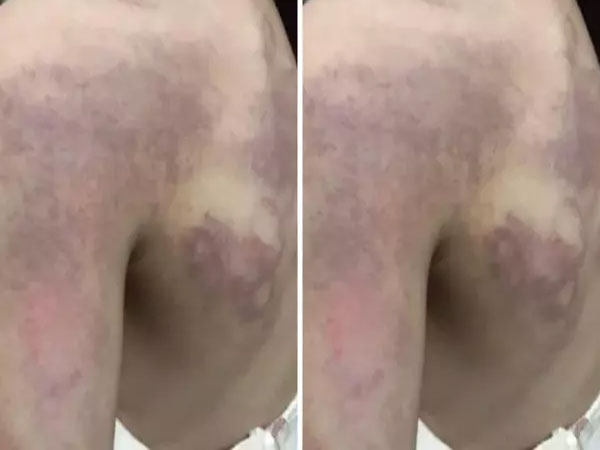 Học sinh lớp 3 nghi bị cô giáo dùng thước đánh tím người vì... không làm được bài