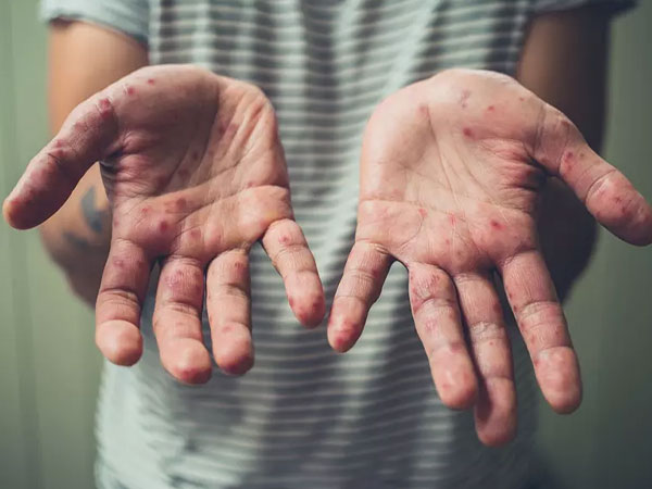 Người lớn mắc bệnh tay chân miệng có nguy hiểm không?