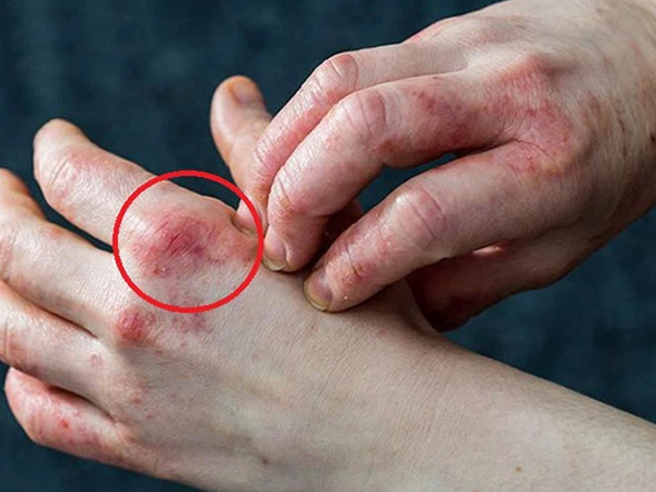 8 dấu hiệu cảnh báo đường huyết tăng vọt và cách xử lý