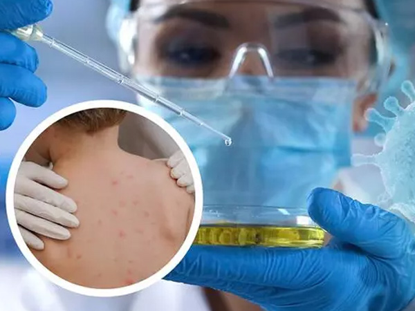 120 ca mắc, nghi mắc đậu mùa khỉ trên thế giới, Việt Nam giám sát chặt chẽ