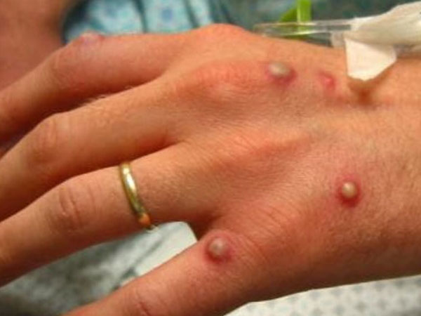 Bệnh đậu mùa khỉ bùng phát: Triệu chứng, cách phòng ngừa và điều trị