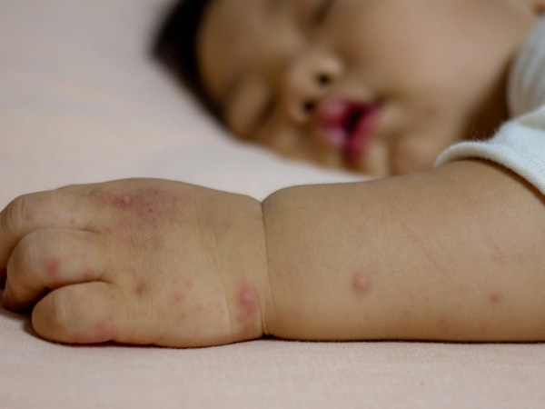 Chăm sóc trẻ bị tay chân miệng tại nhà: Cha mẹ cần lưu ý gì nếu không muốn con phải nhập viện, thở máy?