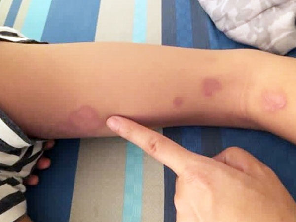 Phát hiện 1 bệnh nhi mắc bệnh 'vi khuẩn ăn thịt người'