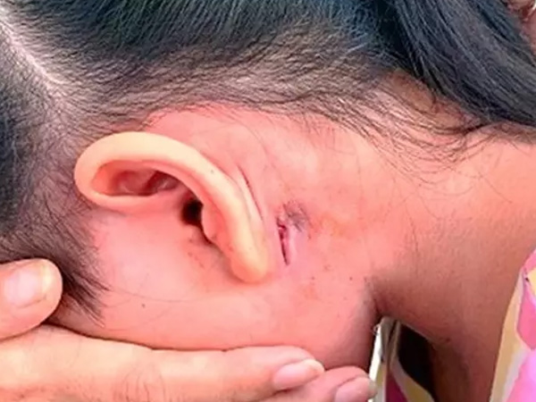 Bé gái 9 tuổi nhiễm 'vi khuẩn ăn thịt người'