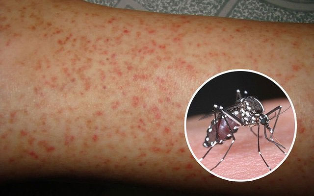 Tử vong do sốt xuất huyết tăng cao: 6 triệu chứng bệnh trở nặng không thể bỏ qua
